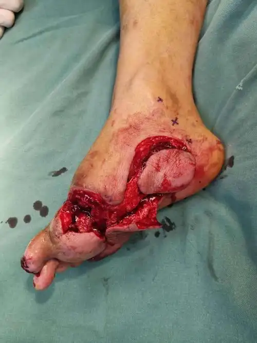 断足再植术后部分坏死,足底内皮瓣修复
