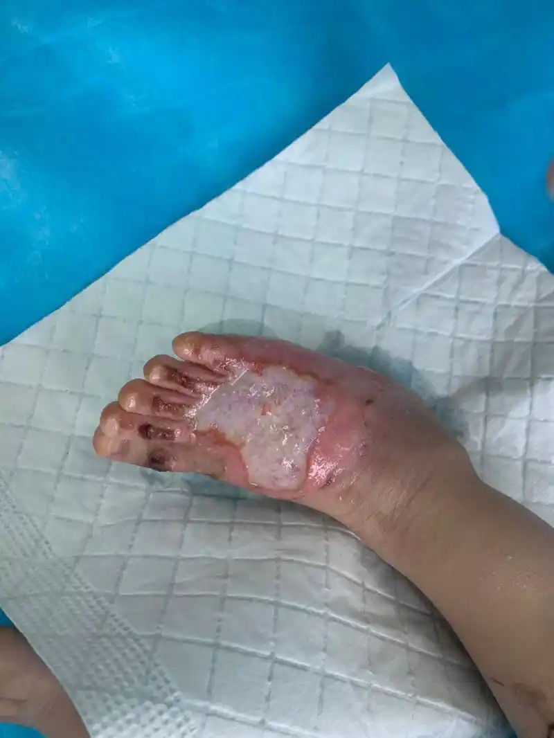 深二度烫伤求助