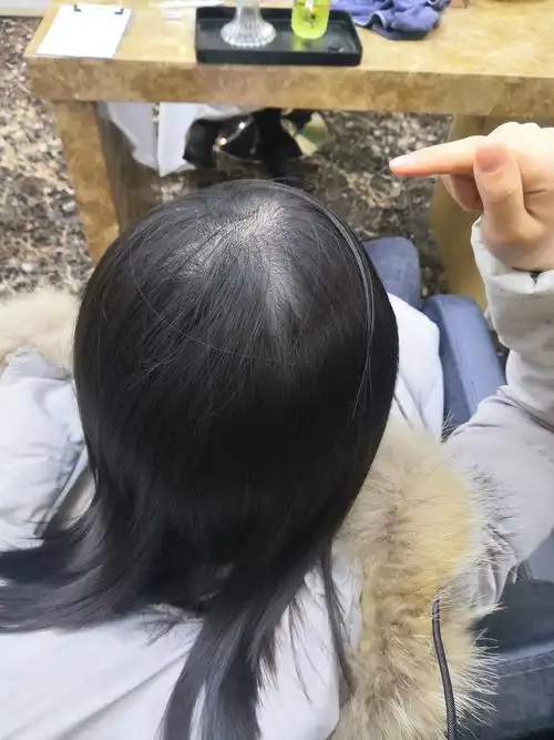 女生头顶头发少是什么体验 ?