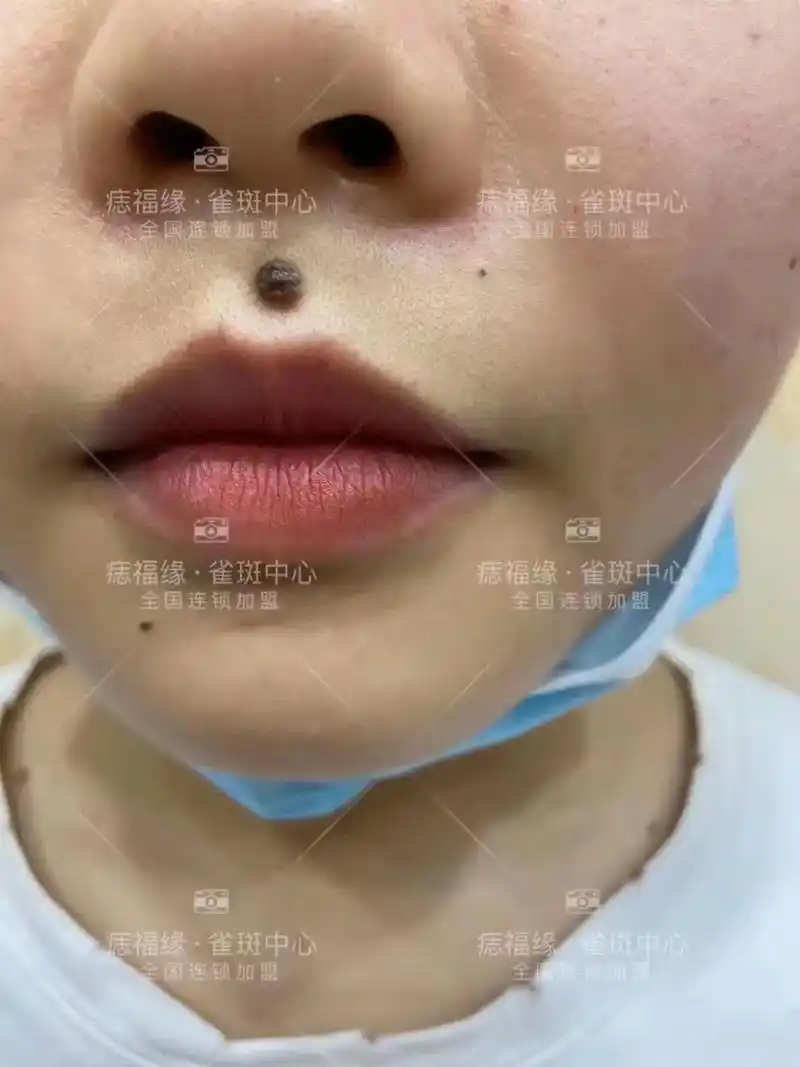 痣变.很长说都人多在嘴上面的痣是福气,不缺吃,根据痣相相面和 - 抖音