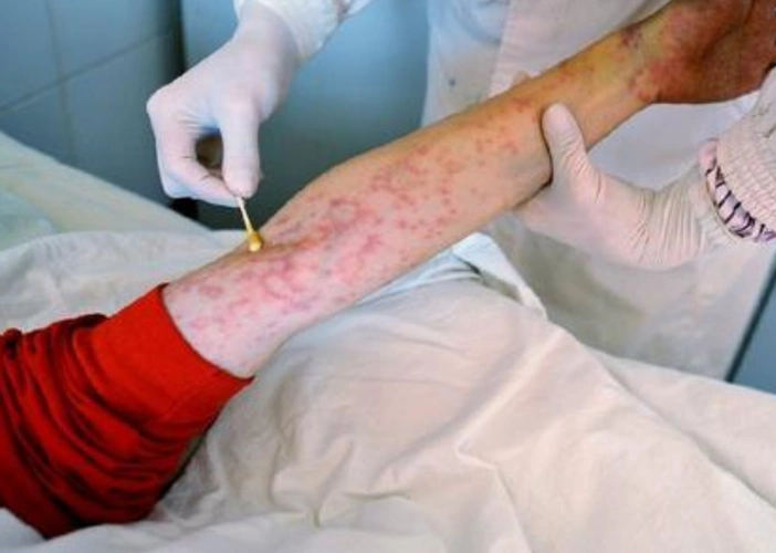 艾滋病舌部图片