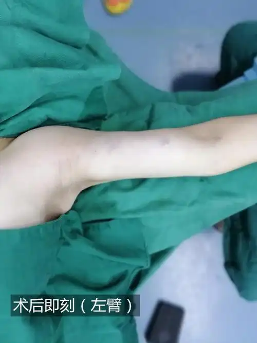 【手臂 后背 副乳抽脂】体验分享