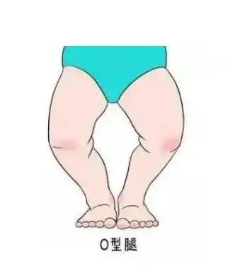 谣言粉碎机31宝宝穿纸尿裤导致o形腿红屁股