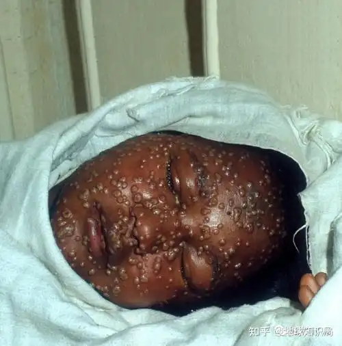 美国药企惊现「天花病毒」,盖茨警告要为「生物恐袭」做好准备,天花