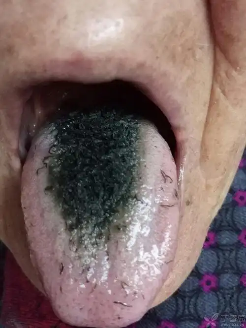 舌苔变绿 - 丁香热点 -丁香园论坛