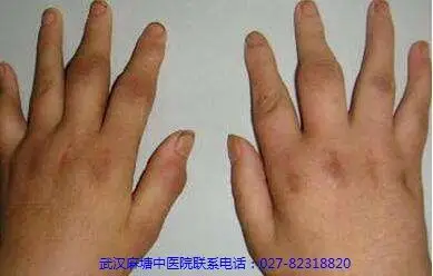 手指类风湿性关节炎.jpg