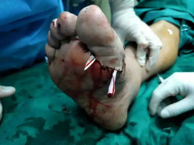 足拇趾离断再植术