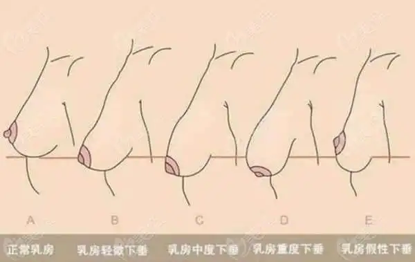 如:假体隆胸失败修复手术,巨乳缩小术,乳房重度下垂矫正等