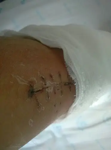 的线,自己把夹板拆了,试了试走路,脚踝上下活动涨痛,伤口右侧肌肉动一