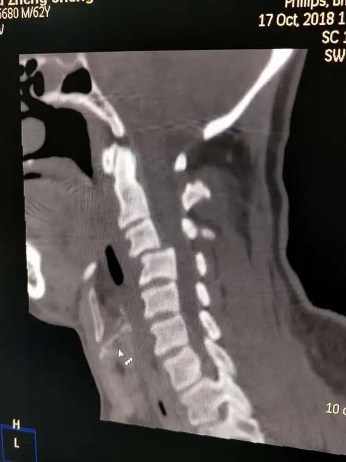 一例高位颈椎脱位并不全瘫患者的救治经过
