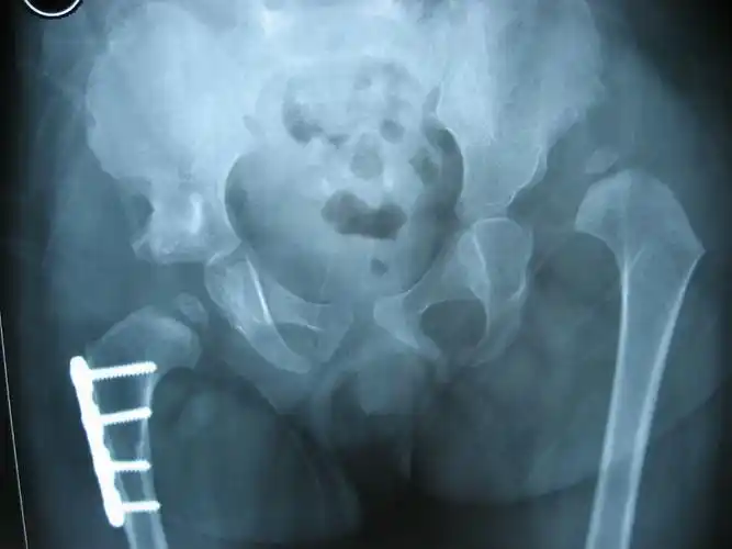 ddh包括髋关节脱位,半脱位和髋臼发