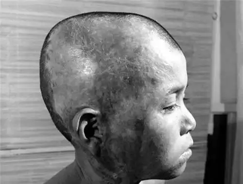 原子弹轰炸过后留下很多核辐射,眼前这名小男孩才十几岁,全身腐烂头发