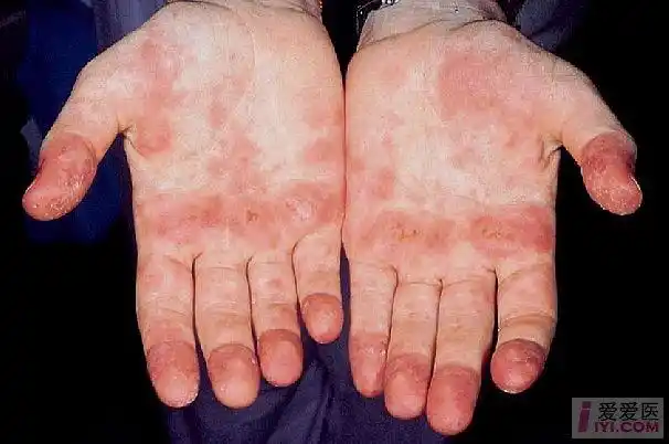 分享红斑狼疮皮肤改变图片集