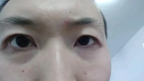 有没有什么好的办法就是我眼尾下眼睑凹陷部位还不是疤_圈子-新氧美容