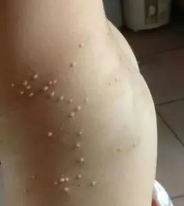 大人儿童去除传染性软疣水猴子病毒性软疣宝宝 私处特殊软尤扁平