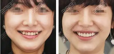 矫正案例前后对比