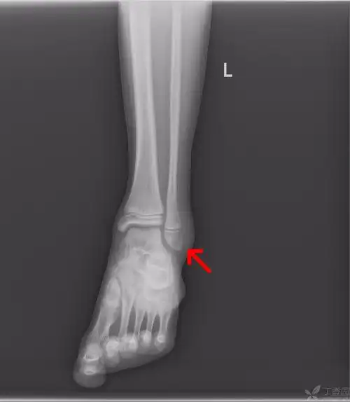 39-外踝骨折 m11y外伤后左外踝肿痛,活动受限1小时余