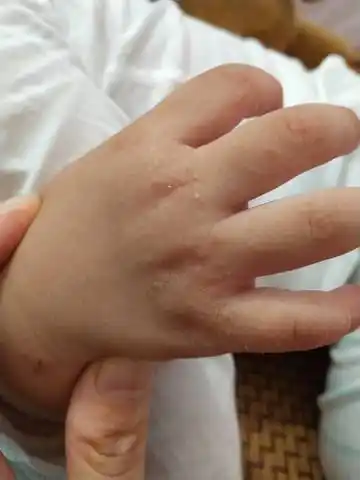 宝宝长了疥疮一年了.还没好,大家有什麼好的治疗方法推荐