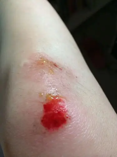 跌伤膝盖怎么处理?红药水还是紫药水还是双氧水?急!>_ 好痛_百度知道