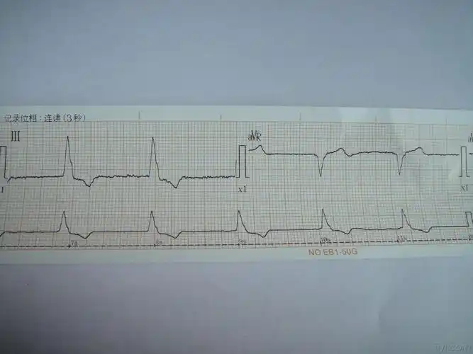 交界性逸搏心律? - 心电图脑电图专业讨论版 - 爱爱医医学论坛