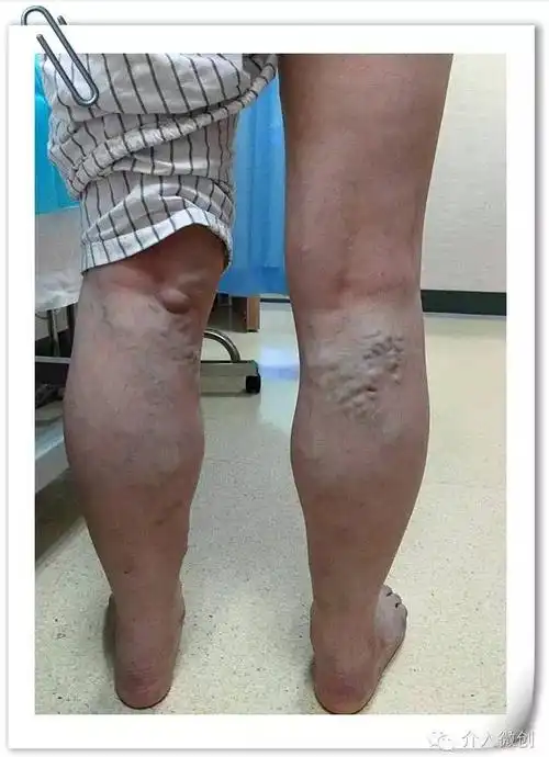 单纯性下肢浅静脉曲张的病因发病机制临床表现及介入治疗