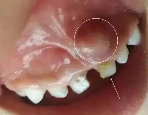 孩子的牙龈起脓包,要看医生吗?吃药能好吗?