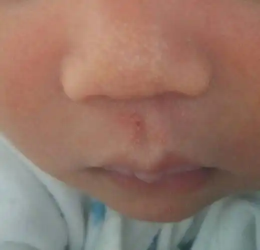 问:宝宝出生鼻子上就有这个白点点,请问是什么,如何处理?