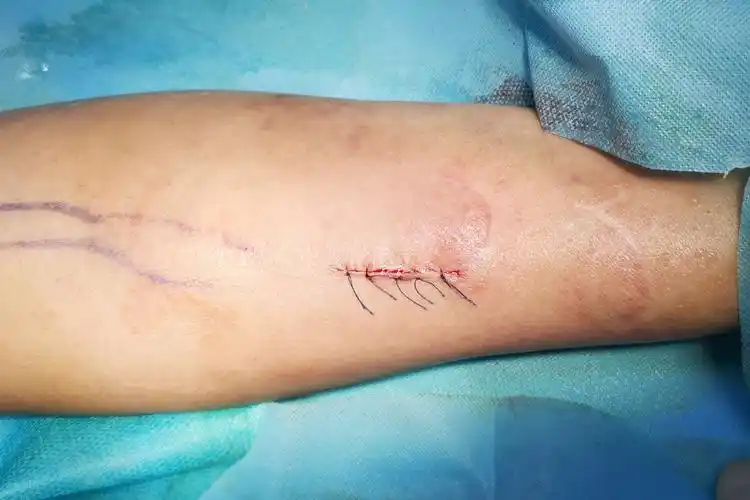 高流量内瘘 大房缺心脏