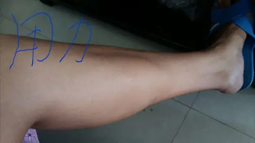 半月前发现左边小腿肌肉内侧多出一块,不知道是什么用力就突出,放松没