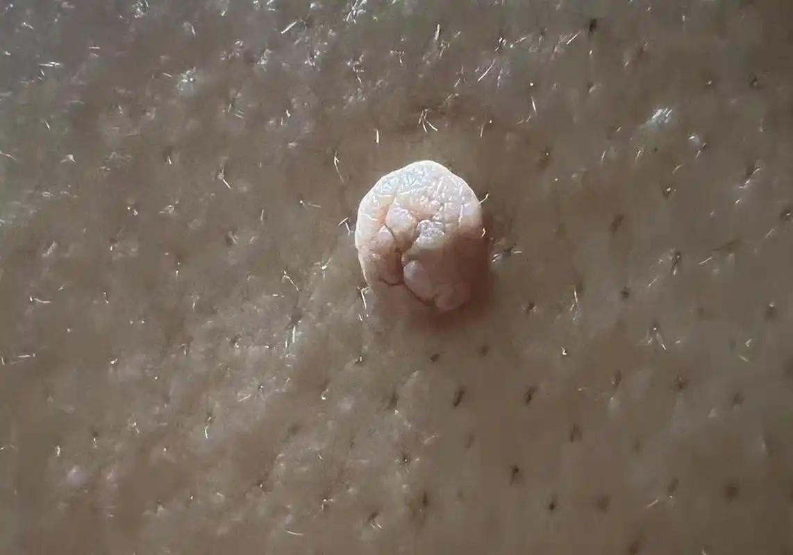 中国医师节# 后背上和腋下长了小肉疣,后背上的有点大了,而且最近后背