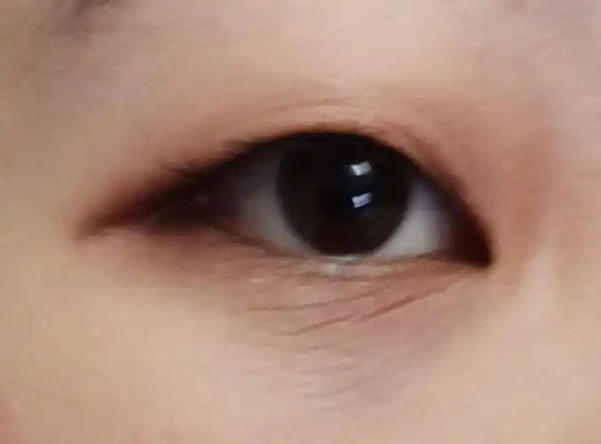 问一下眼睛下面这种皱纹是什么名字这种是可以做手术吗