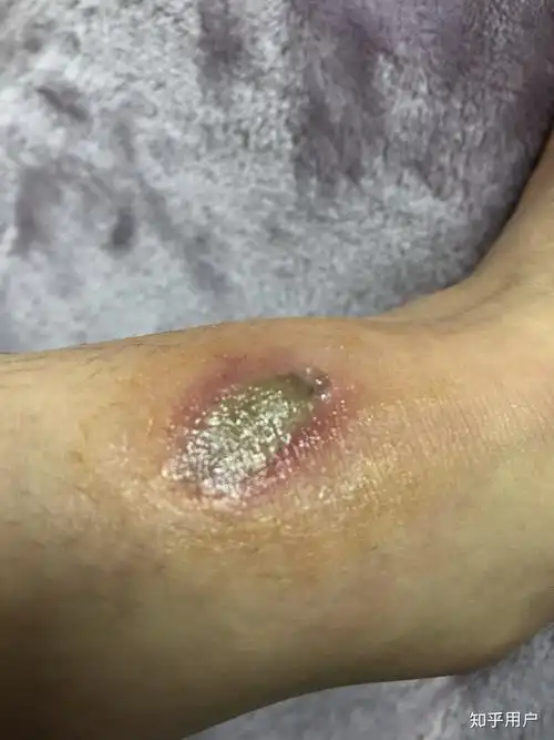 被毒蚊子咬了肿了很大一个包还很硬之后肿的包上面起了水泡挑破之后第