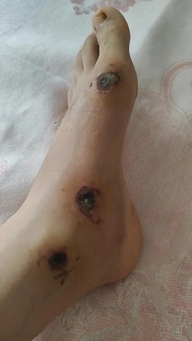 寒江风雪 #有一种疼叫做看着都疼 ,骑车摔倒擦伤,创面比较 - 抖音