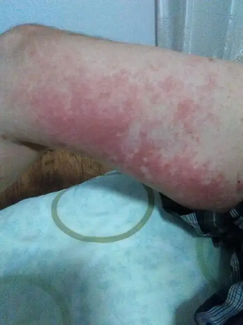 全身起红斑,甚痒,一个月了用药没效果.起皮一层一层的.去市人民医院看