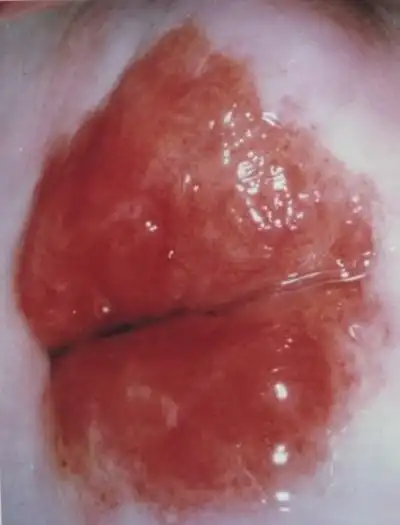 宫颈癌图片 (32)