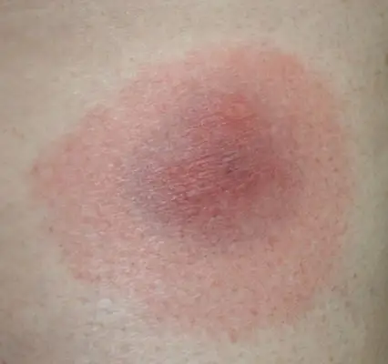 蚂蚁咬人后症状图片27