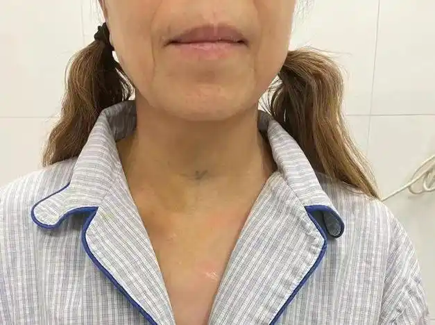 平时穿衣后,瘢痕可遮挡适应症1该术式适用于单侧甲状腺良恶性肿瘤2