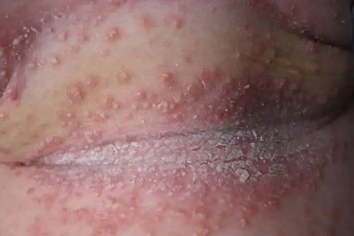 红斑丘疹糜烂图片