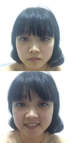 为什么一照片嘴巴就是歪的,这个需要做手术纠正么.脸一直脂肪比较多