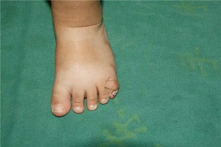 我们创建了系列新术式治疗小儿先天脚趾畸形,改变了国内外原来都需要
