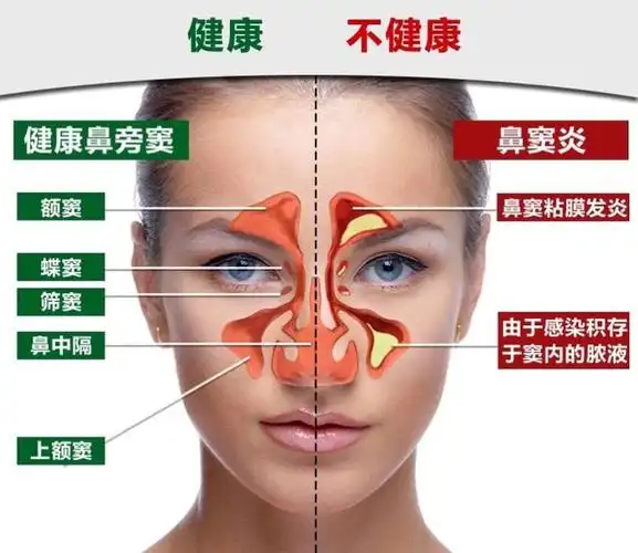 鼻炎鼻窦炎案例