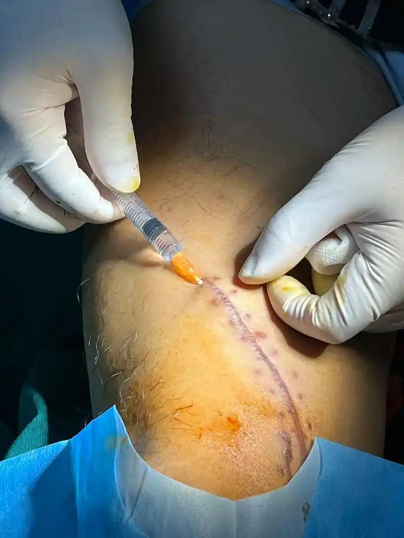 严重受伤后普通外科缝合.由于疤痕增生,每天下午 - 抖音