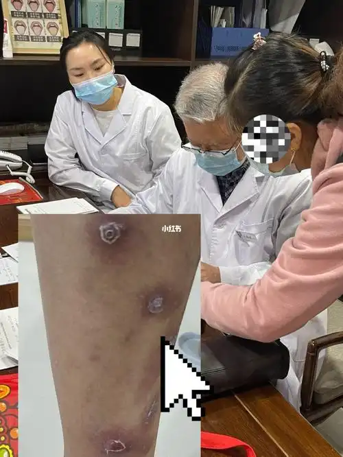 这是一种特殊的湿珍叫做结节性痒珍