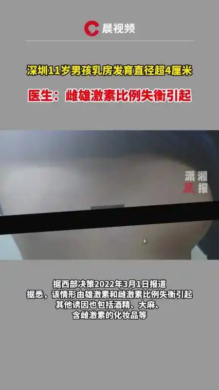 11岁男孩乳房发育直径超4厘米医生因雌雄激素比例失衡