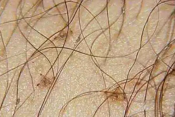 虱子是怎么产生的人为什么长虱子