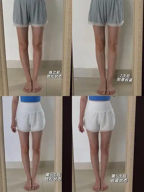 直腿训练打卡小腿外翻矫正