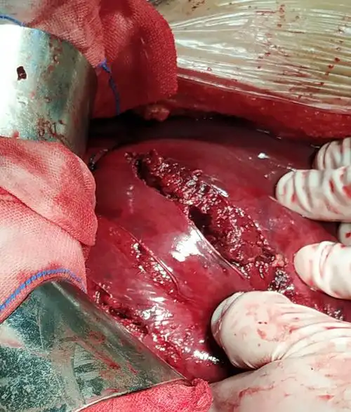 急诊行外伤后脾破裂脾切除术.