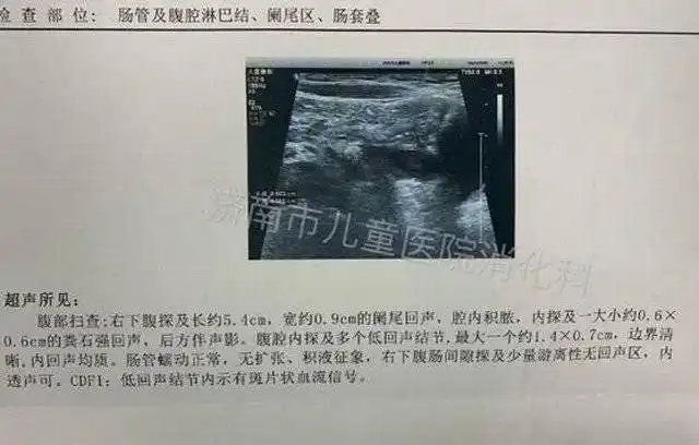 消化科主任徐俊杰看诊后,结合彩超回报诊断为"粪石性阑尾炎"