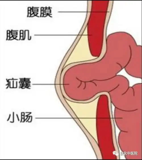 勿以疝小而不为