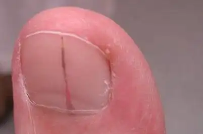 心脏不好指甲会有4个异常手指还有3个表现养好心脏才安康